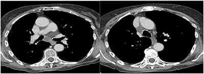 A lymph node mediastinal foreign body reaction mimicking nodal metastasis: A case series